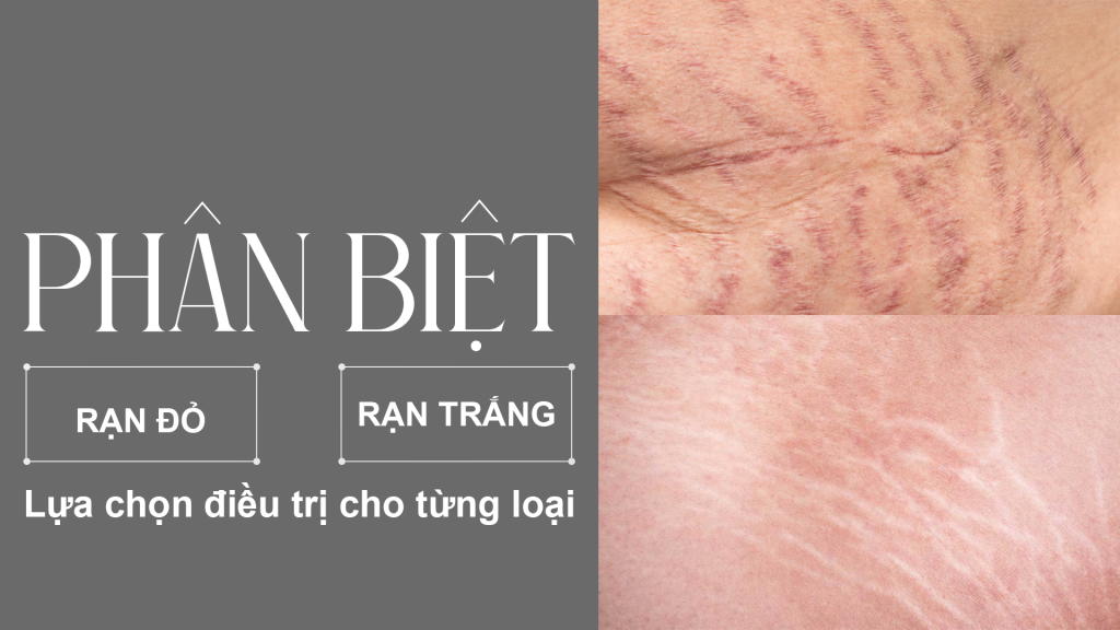 Phân biệt rạn da đỏ và rạn da trắng cùng giải pháp điều trị hiệu quả