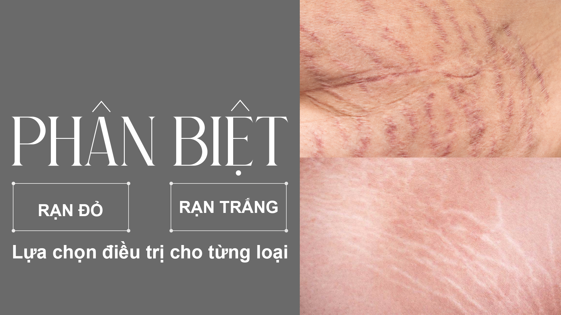 Phân biệt rạn da đỏ và rạn da trắng cùng giải pháp điều trị hiệu quả