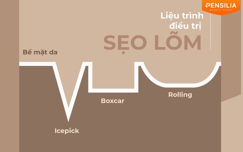 Sơ đồ minh họa các dạng sẹo lõm phổ biến bao gồm sẹo chân đá nhọn icepick sẹo chân vuông boxcar và sẹo lượn sóng rolling