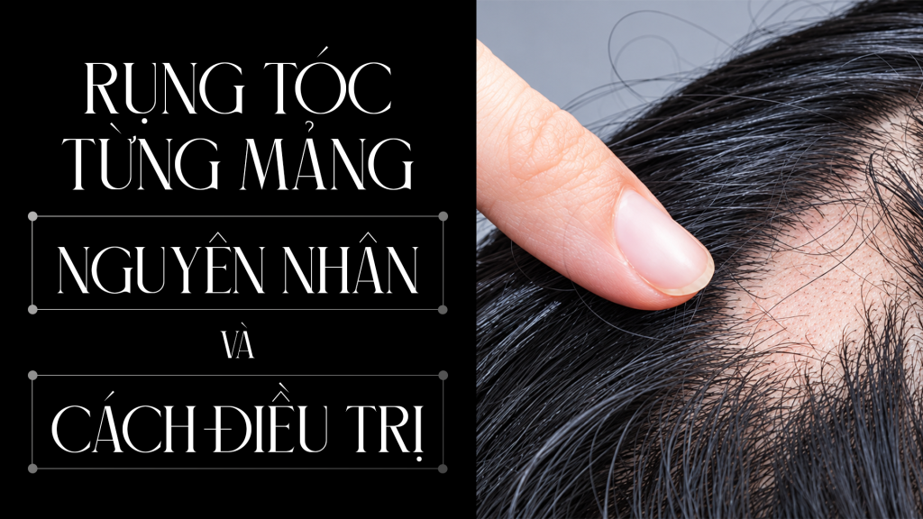 Rụng tóc từng mảng: Nguyên nhân và cách điều trị