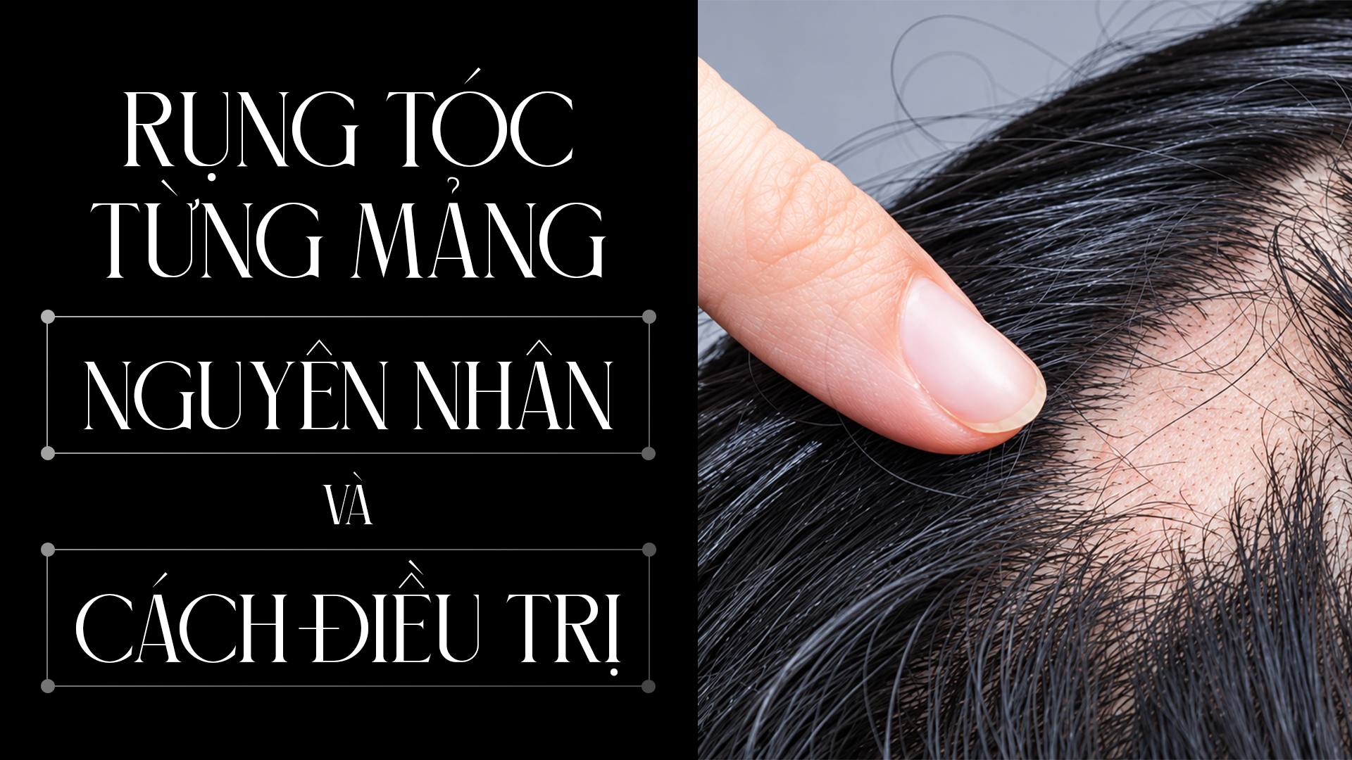 Rụng tóc từng mảng: Nguyên nhân và cách điều trị