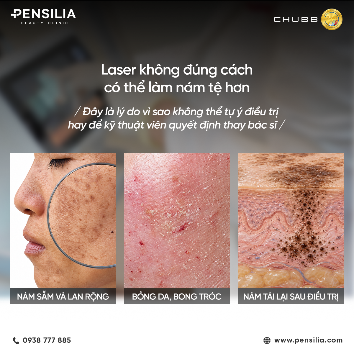 Tác hại của việc bắn laser trị nám sai kỹ thuật như nám sẫm màu, bỏng rát và tăng sắc tố.