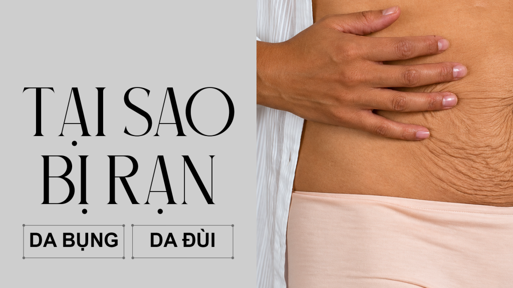 Tại Sao Bị Rạn Da Bụng, Rạn Da Đùi? Nguyên Nhân Và Cách Phòng Ngừa