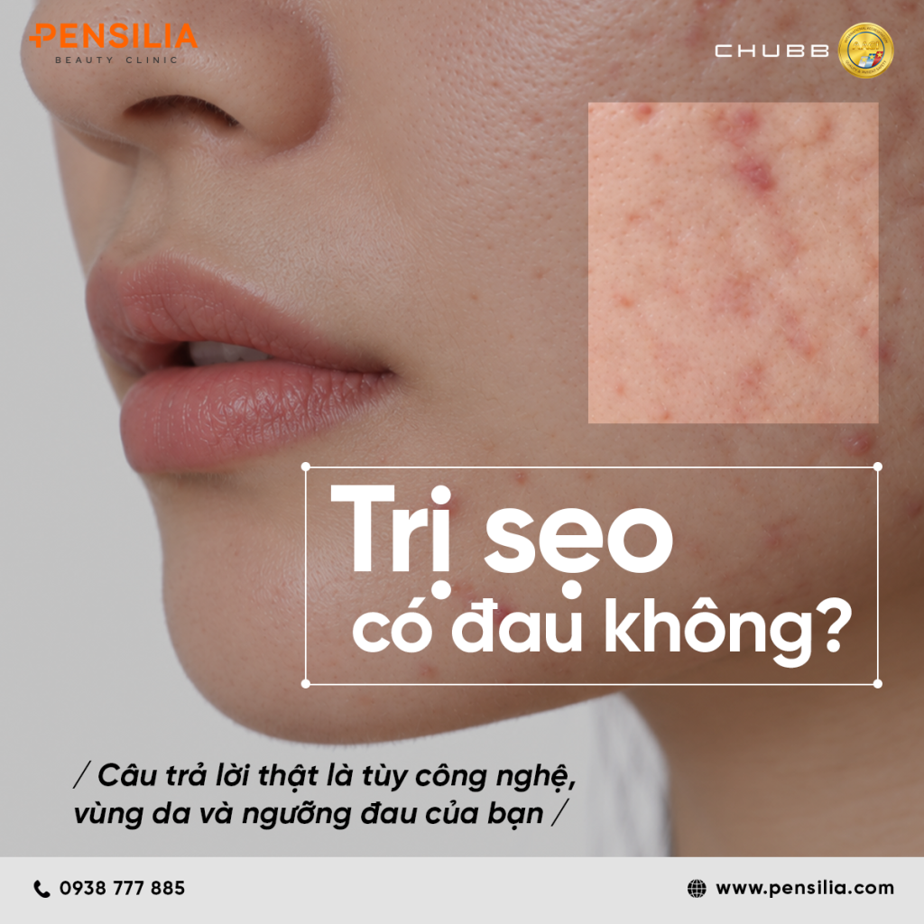 Trị sẹo rỗ có đau không tùy thuộc công nghệ điều trị và ngưỡng đau của từng người