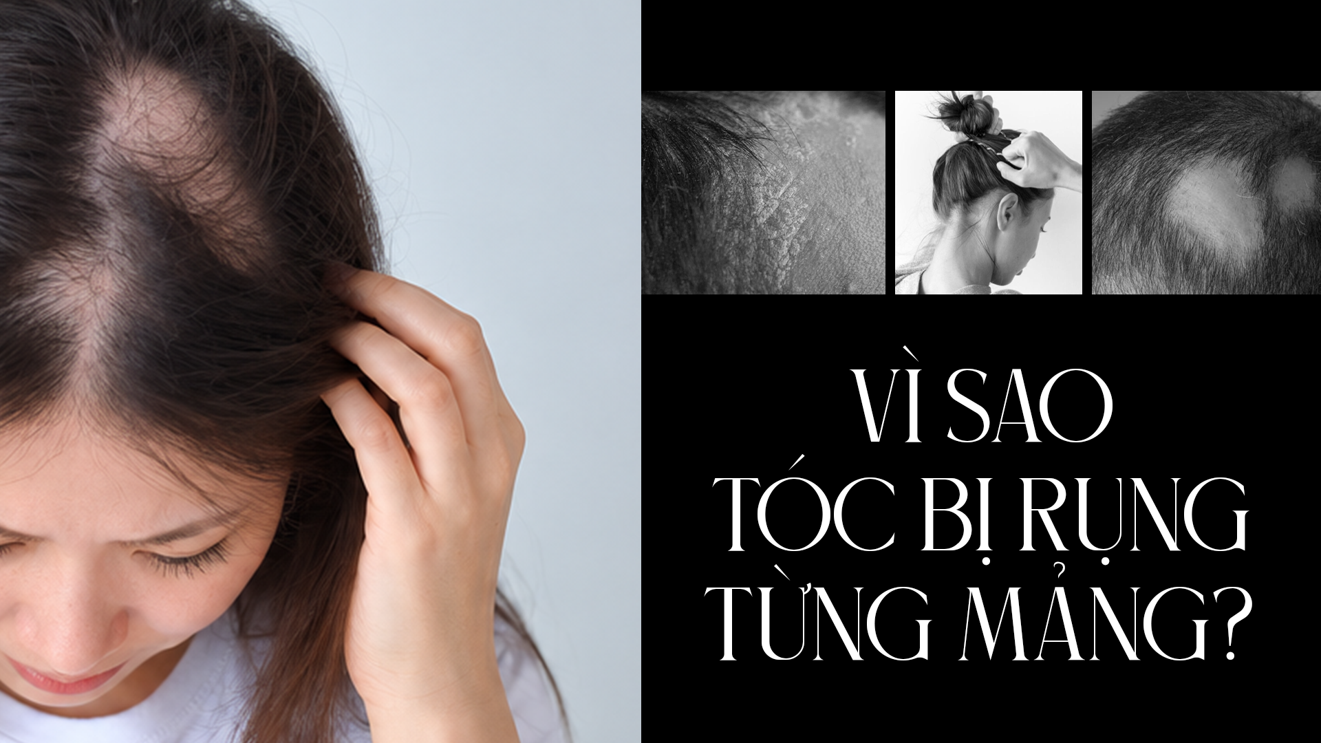 Vì sao tóc bị rụng từng mảng?